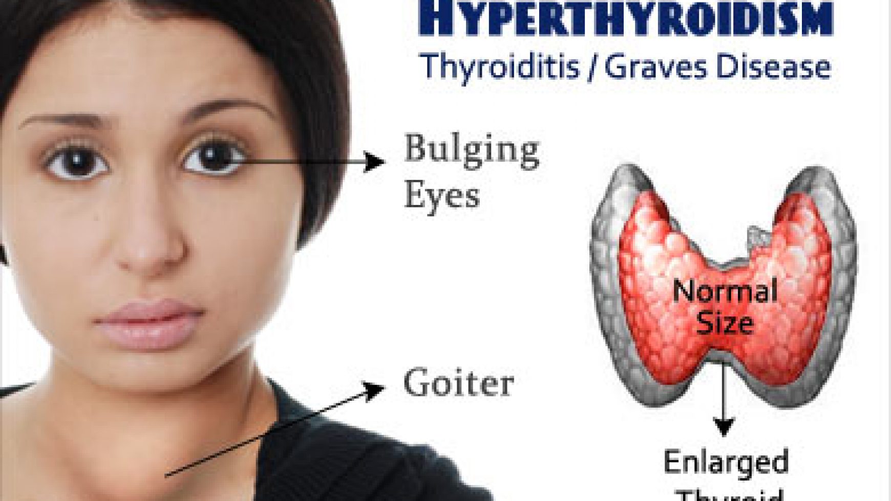 Как называют женскую железу. Гипертиреоз щитовидной железы. Диффузный токсический зоб.